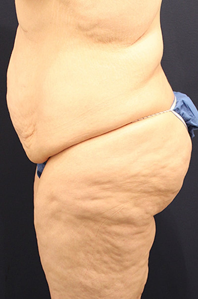 Buttock Fat Transfer Before & After