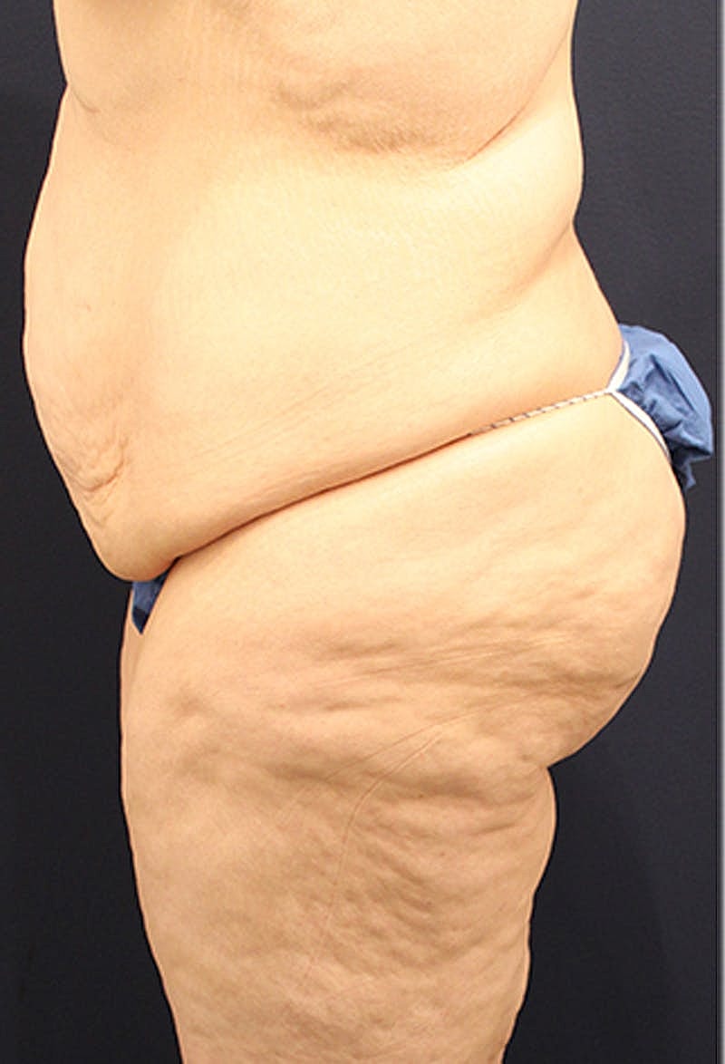 Buttock Fat Transfer Before & After