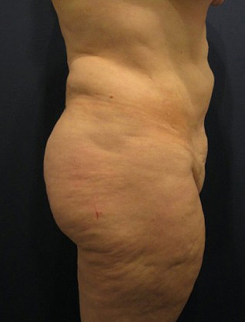 Buttock Fat Transfer Before & After