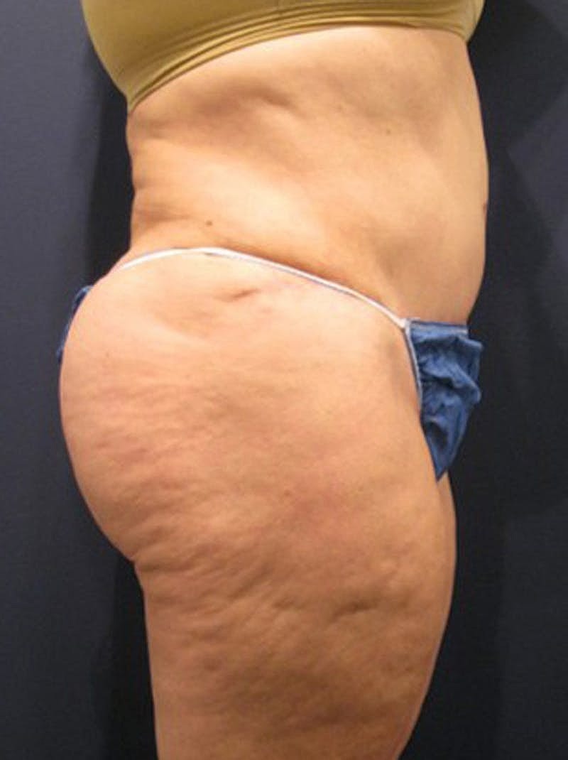 Buttock Fat Transfer Before & After