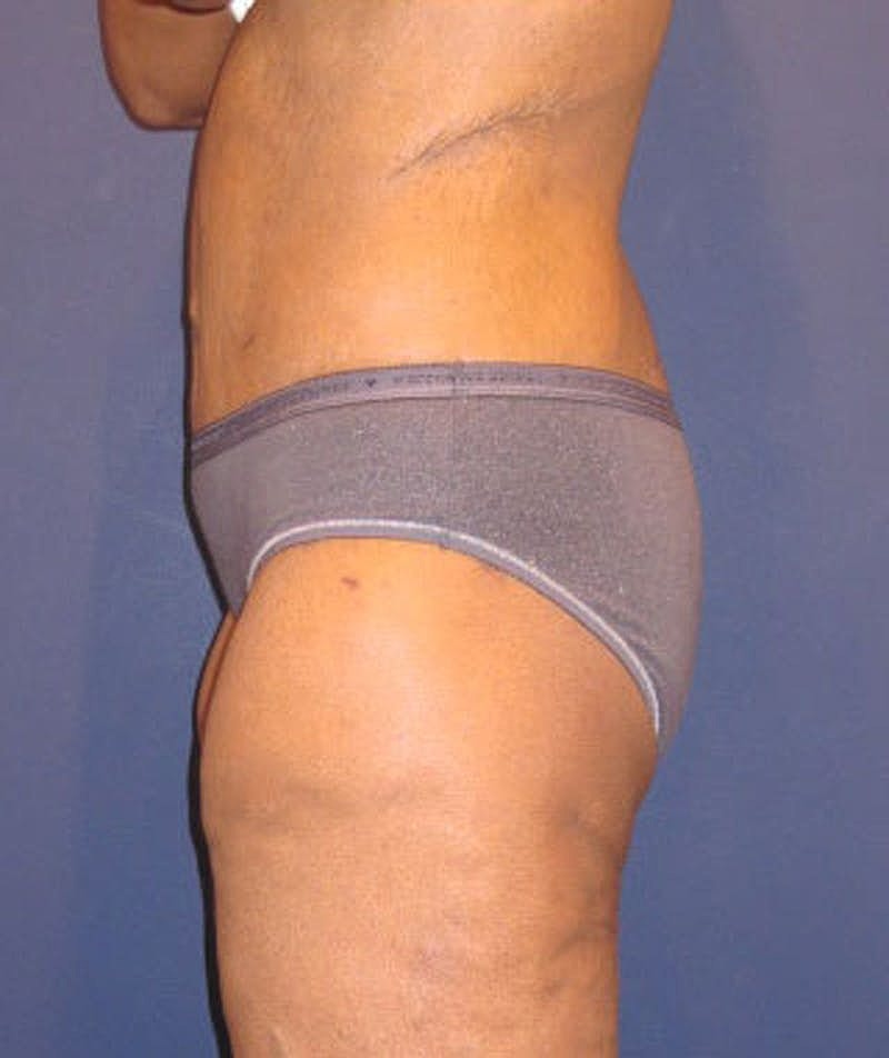 Buttock Fat Transfer Before & After