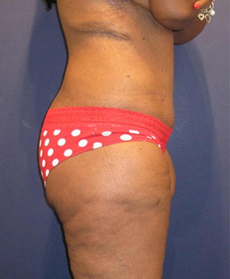 Buttock Fat Transfer Before & After