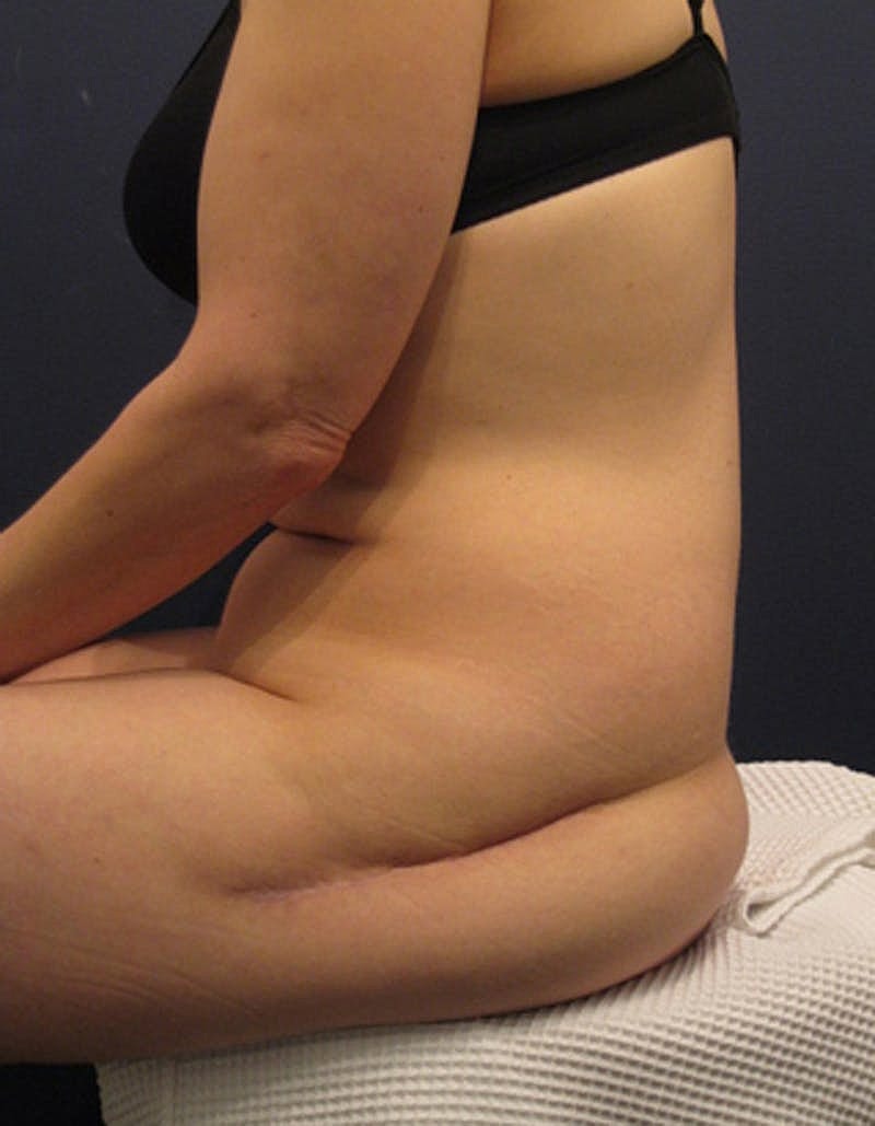 Buttock Fat Transfer Before & After