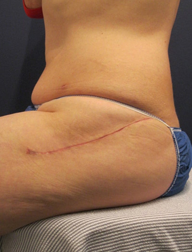 Buttock Fat Transfer Before & After