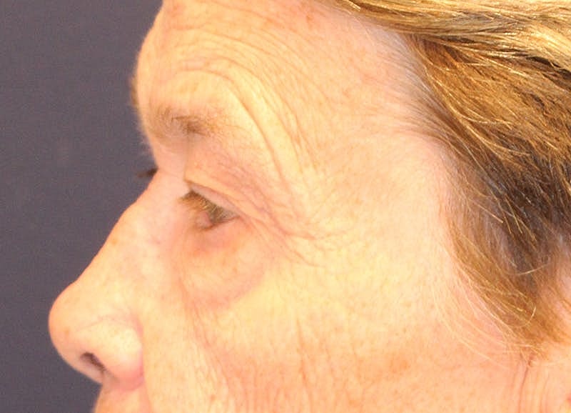 Blephroplasty Before & After