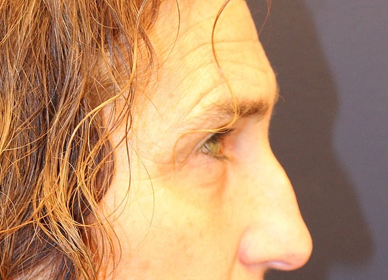 Blephroplasty Before & After