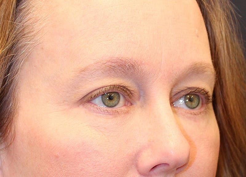 Blephroplasty Before & After