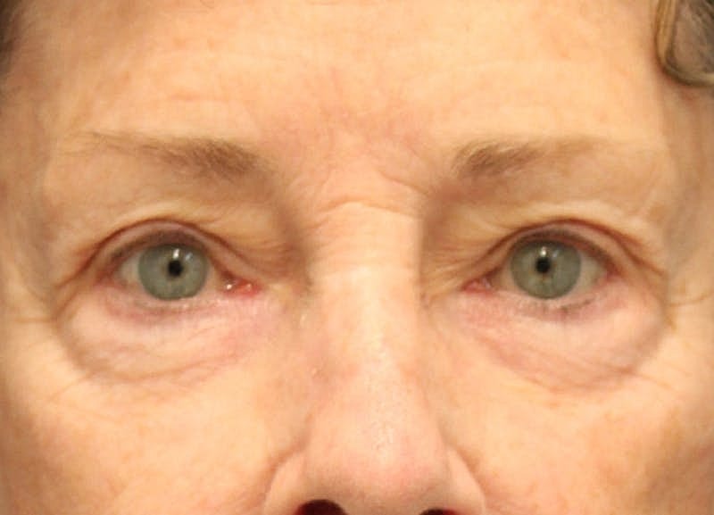 Blephroplasty Before & After