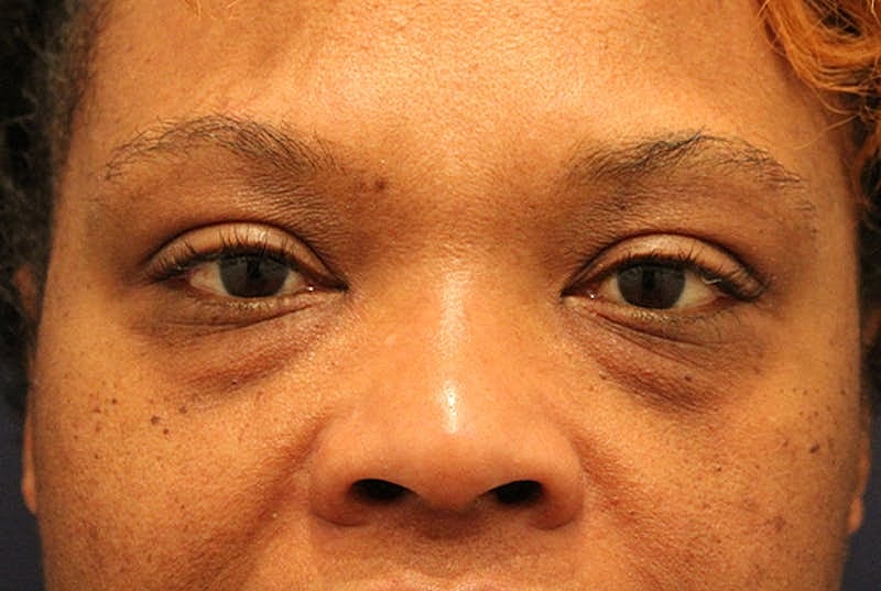 Blephroplasty Before & After