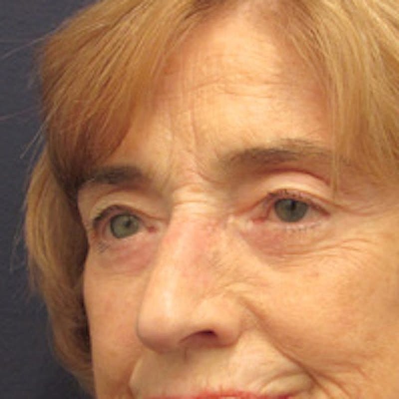 Blephroplasty Before & After