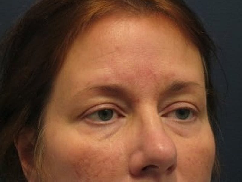 Blephroplasty Before & After