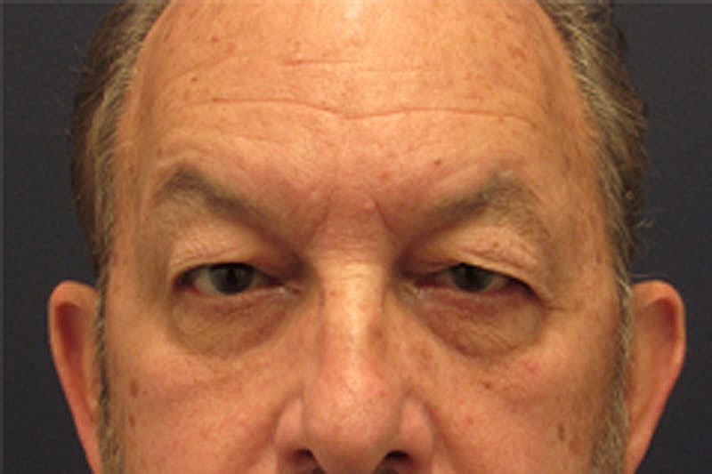 Blephroplasty Before & After