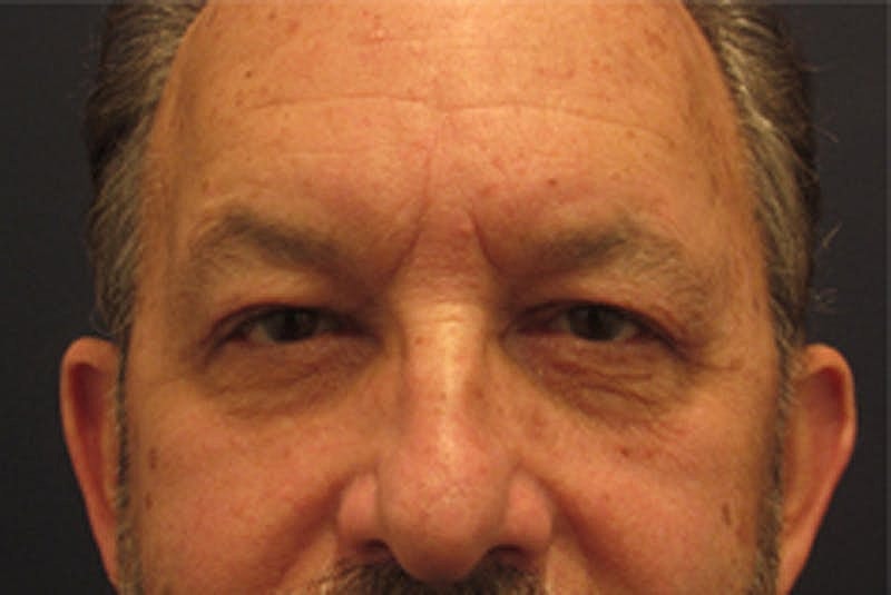 Blephroplasty Before & After