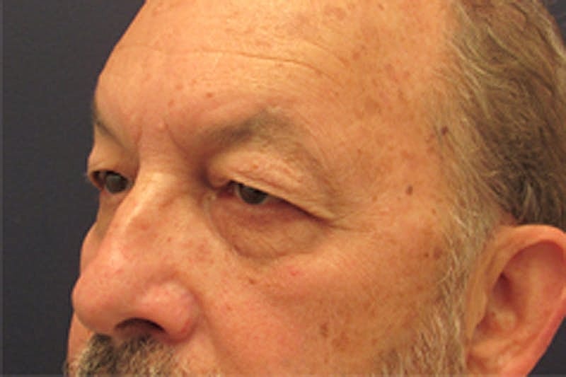 Blephroplasty Before & After