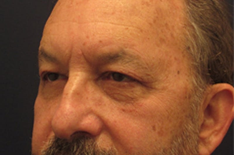 Blephroplasty Before & After