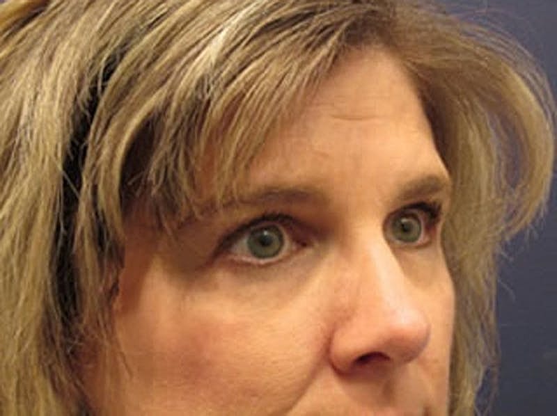 Blephroplasty Before & After