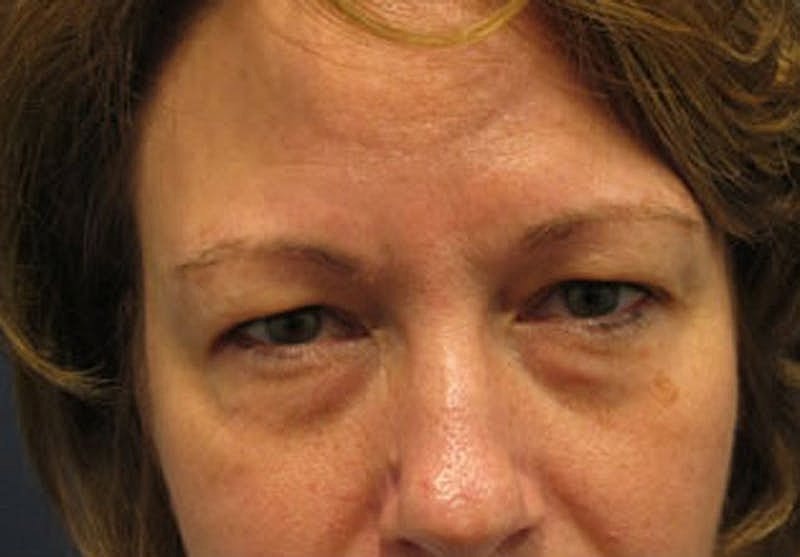 Blephroplasty Before & After