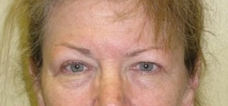 Blephroplasty Before & After