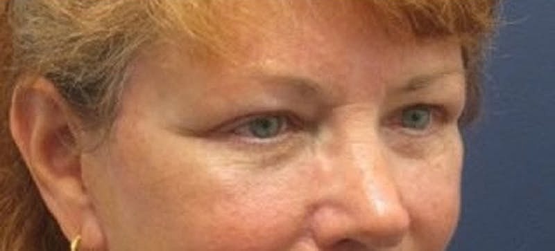 Blephroplasty Before & After