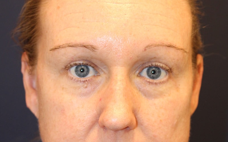 Blephroplasty Gallery Before & After