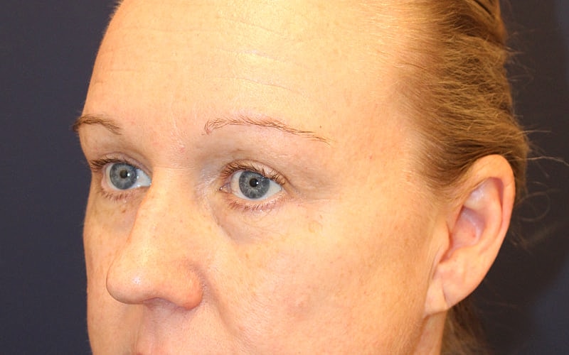 Blephroplasty Gallery Before & After