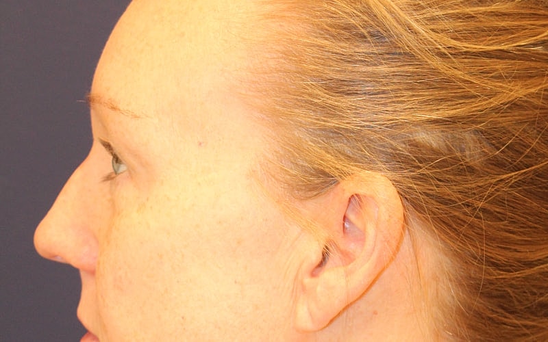 Blephroplasty Gallery Before & After