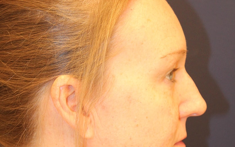 Blephroplasty Gallery Before & After