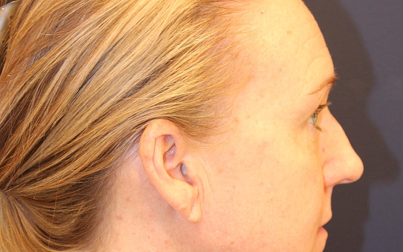 Blephroplasty Gallery Before & After