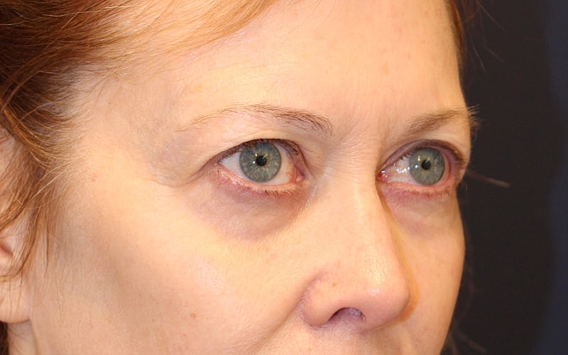 Blephroplasty Gallery Before & After