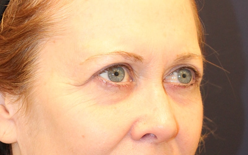 Blephroplasty Gallery Before & After