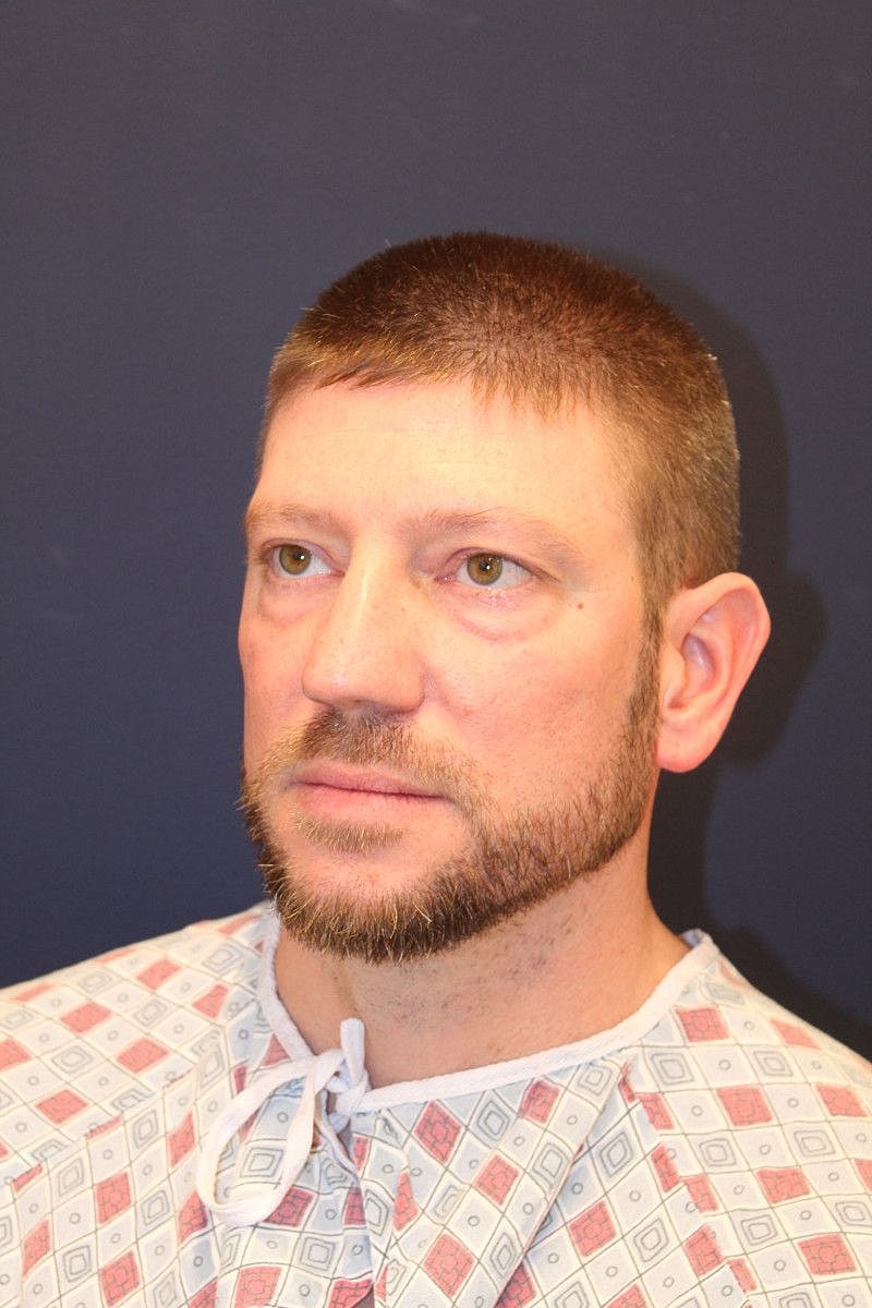 Blepharoplasty Gallery Before & After