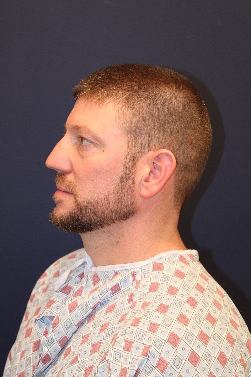 Blepharoplasty Gallery Before & After