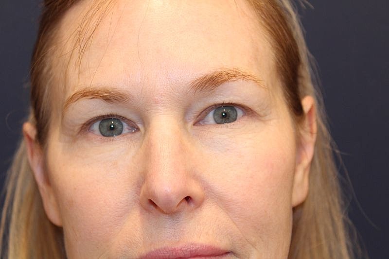 Blepharoplasty Gallery Before & After
