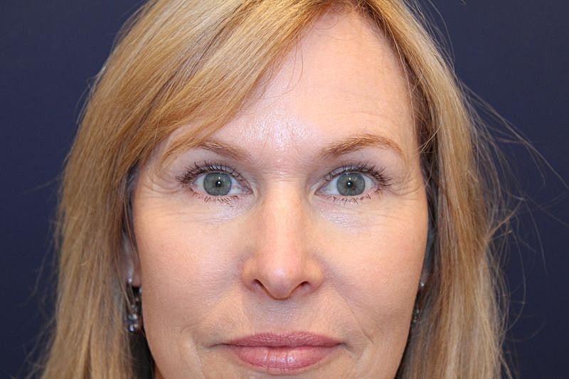Blepharoplasty Gallery Before & After