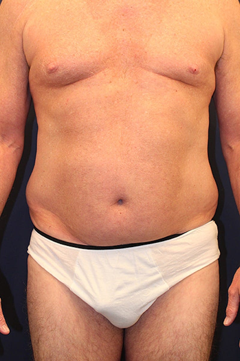 Liposuction Before & After
