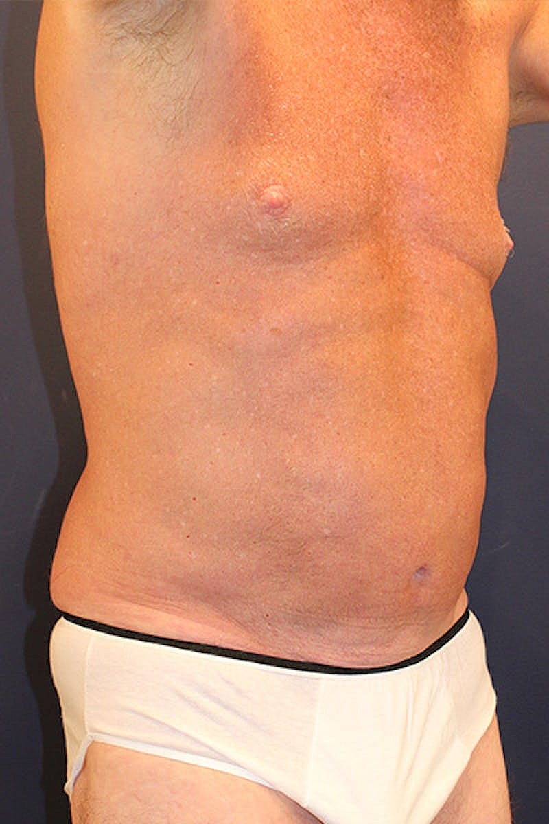 Liposuction Before & After