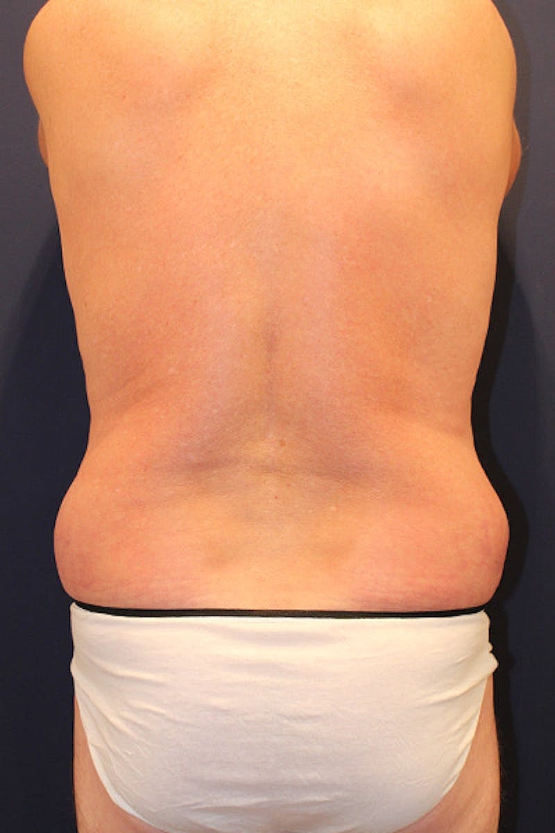 Liposuction Before & After