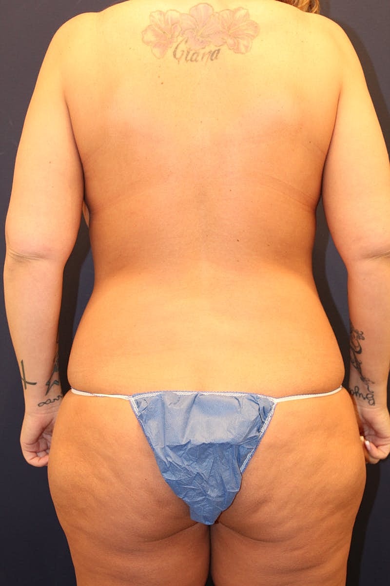 Liposuction Before & After