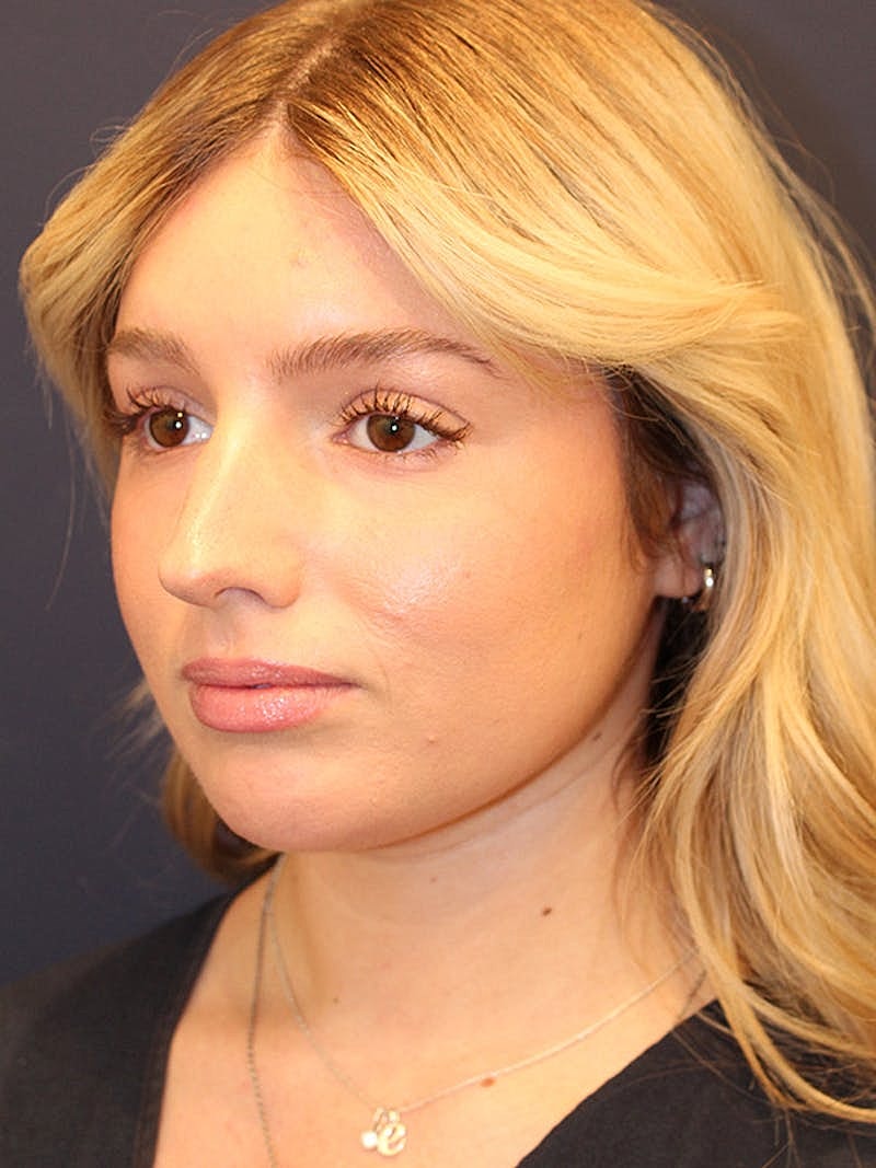 Liposuction Before & After