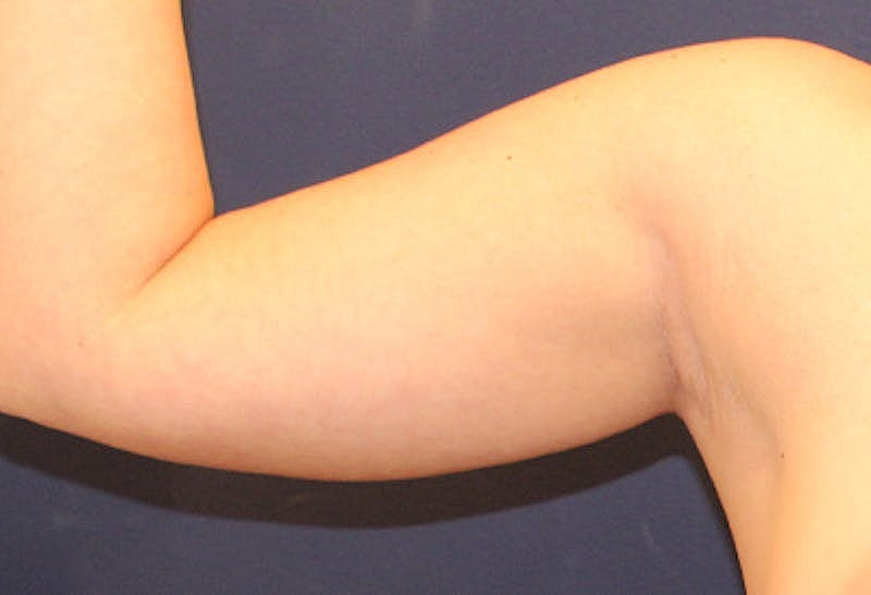 Liposuction Before & After