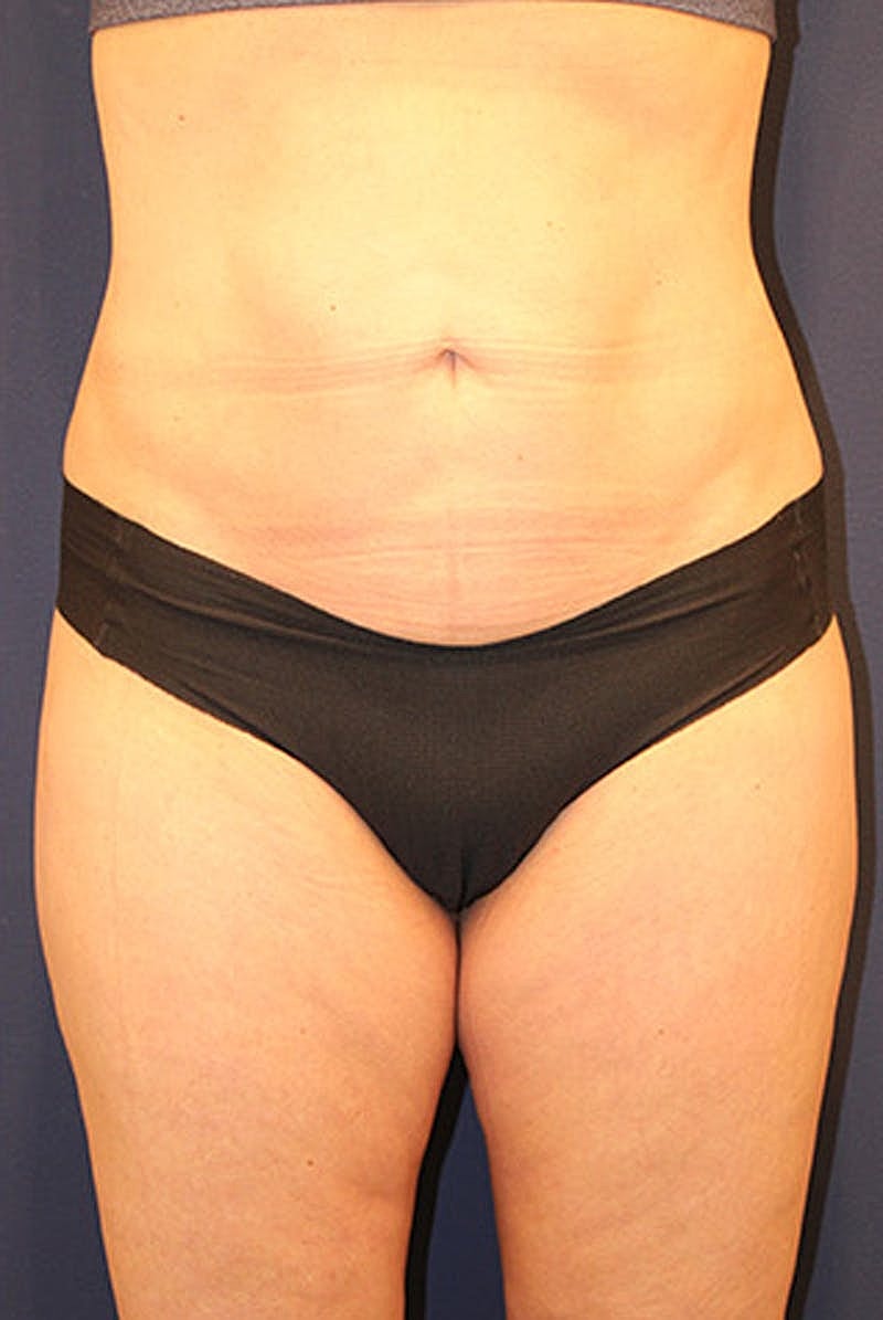Liposuction Before & After