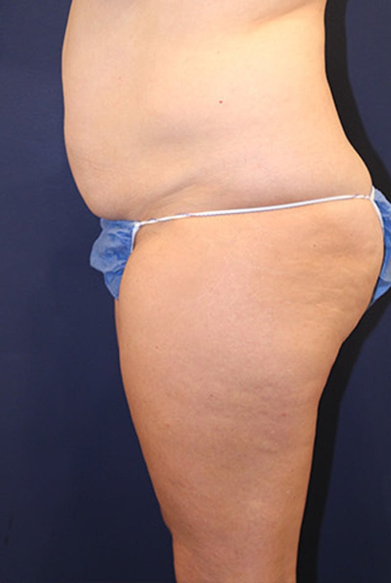Liposuction Before & After