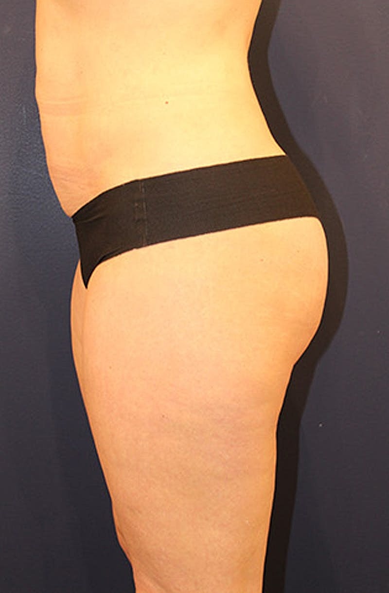 Liposuction Before & After