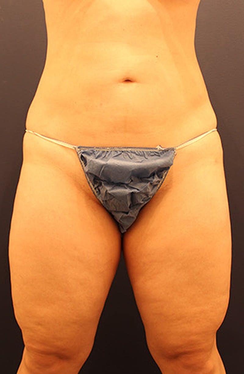 Liposuction Before & After