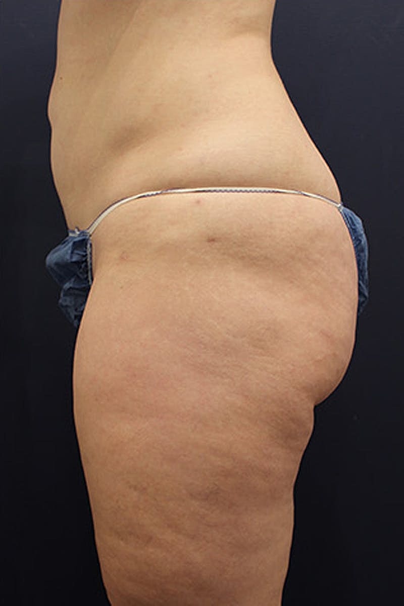 Liposuction Before & After