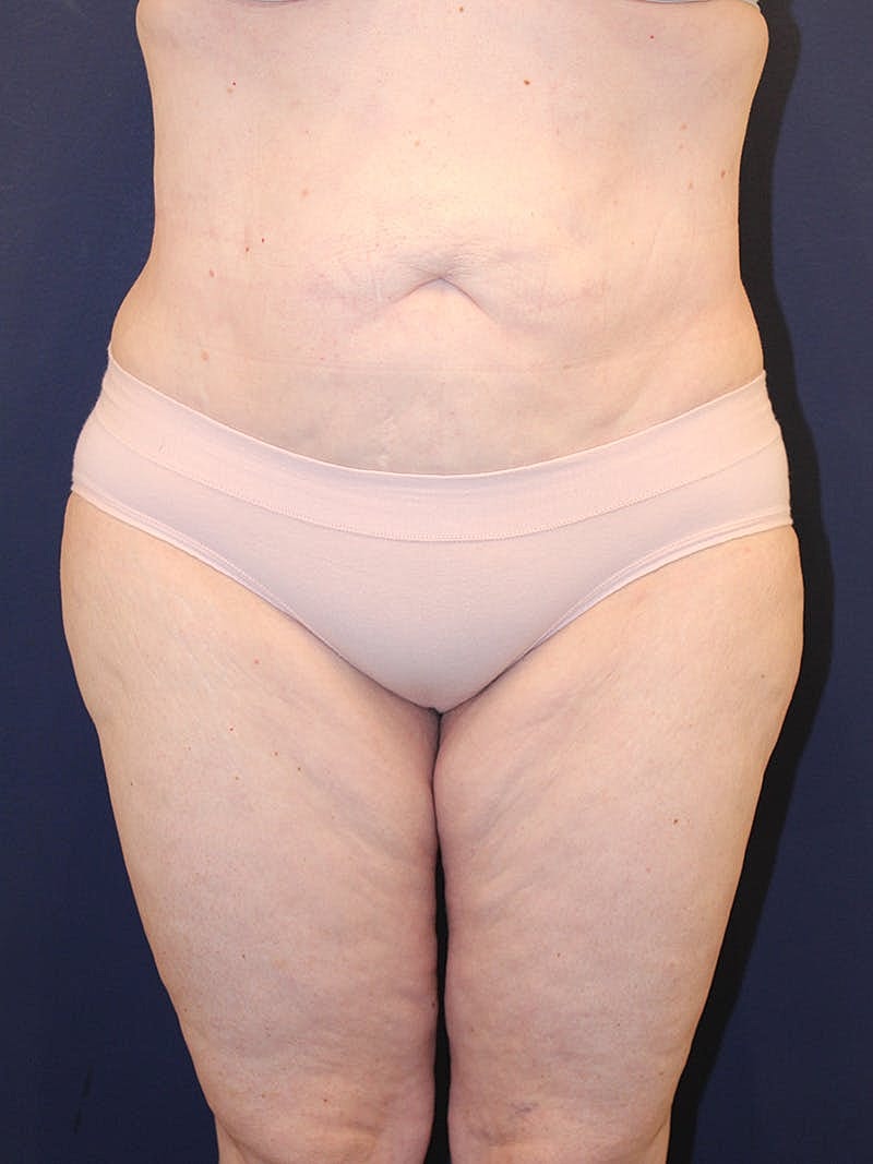 Liposuction Before & After