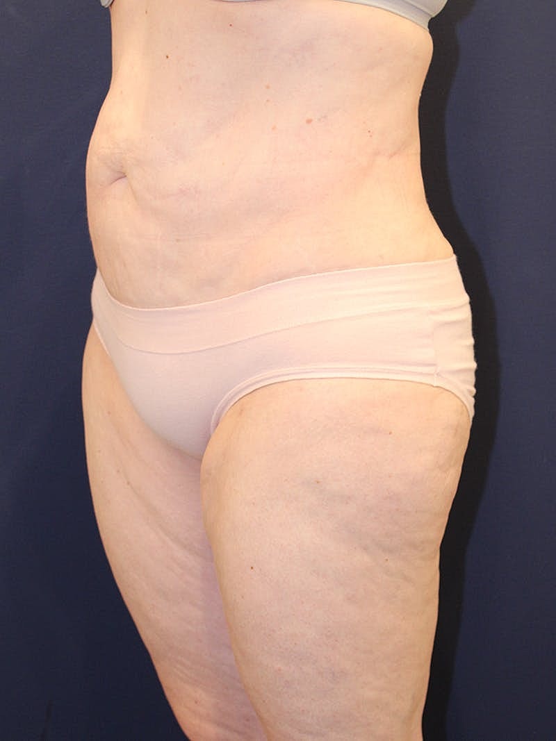 Liposuction Before & After