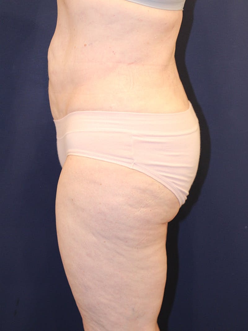 Liposuction Before & After