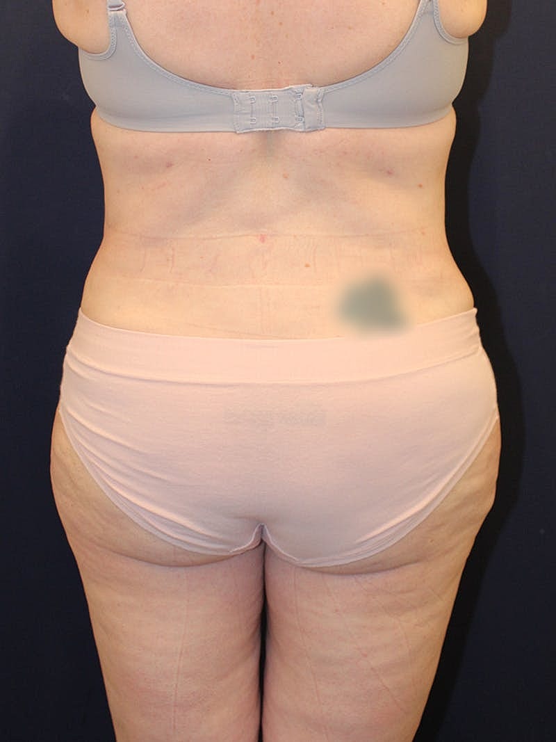 Liposuction Before & After