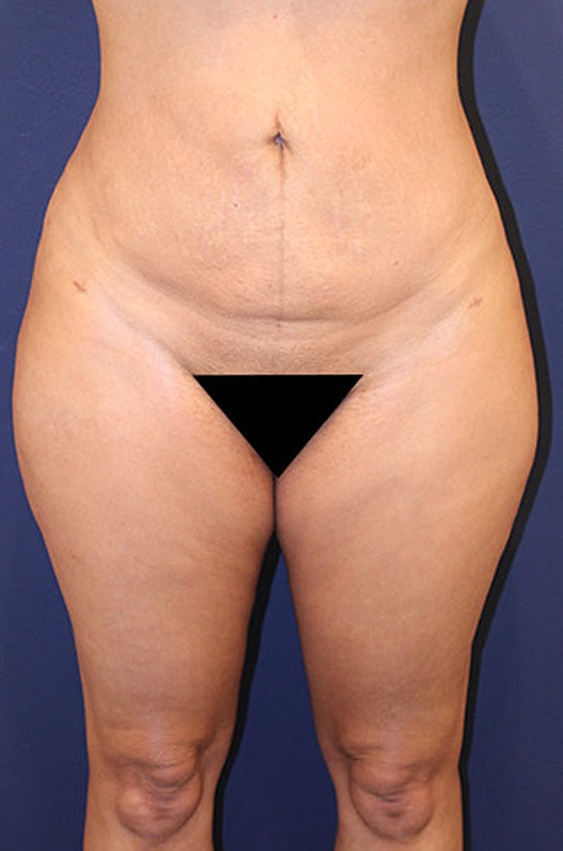 Liposuction Before & After